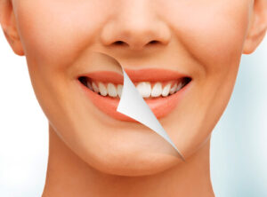 Clareamento Dental Saraiva Odontologia